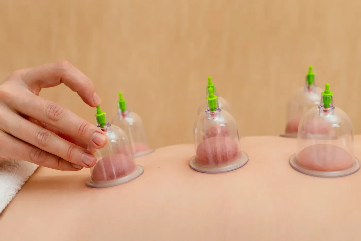 Cupping therapy treatment with cups applied to skin