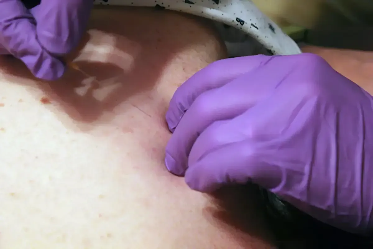 Dry needling treatment targeting muscle trigger points