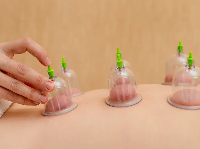 Cupping therapy applied to a patient's back