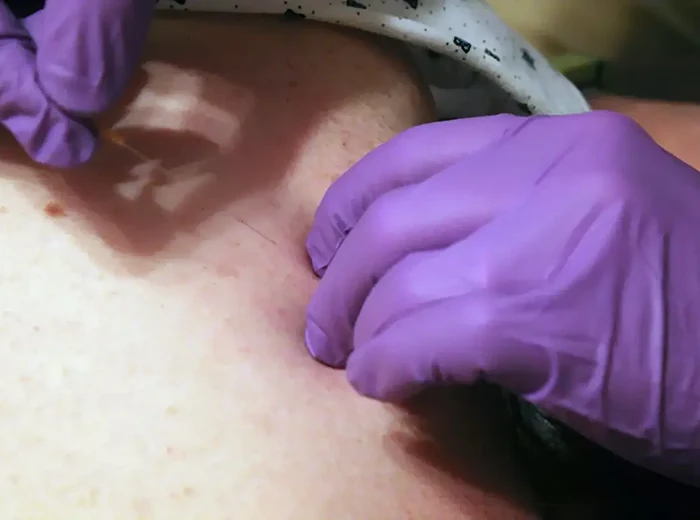 Dry needling therapy